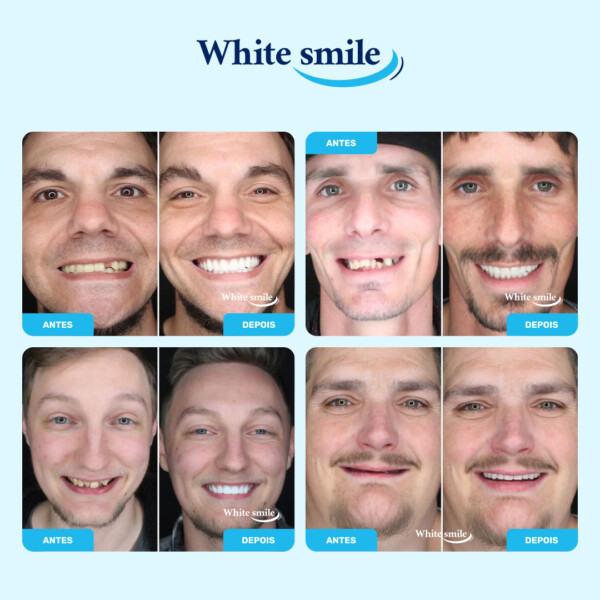 Dentes falsos de aspeto realista: WhiteSmile - Image 3